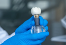 Ar žinote, kiek laiko tarnauja dantų implantas?