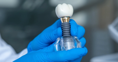 Ar žinote, kiek laiko tarnauja dantų implantas?