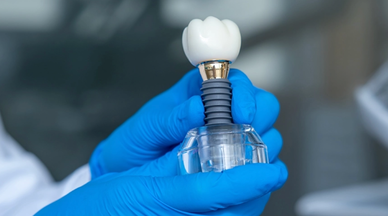 Ar žinote, kiek laiko tarnauja dantų implantas?